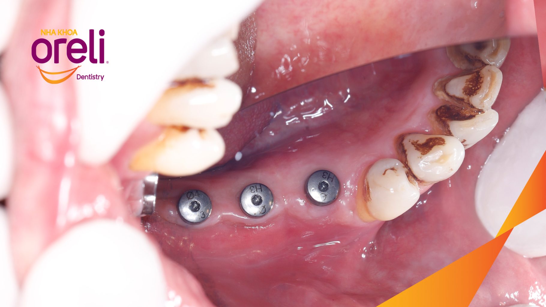 Kết quả đạt được sau 3 tháng - Phục hồi răng mất - ăn nhai chắc chắn và cười nói tự tin tại Oreli
