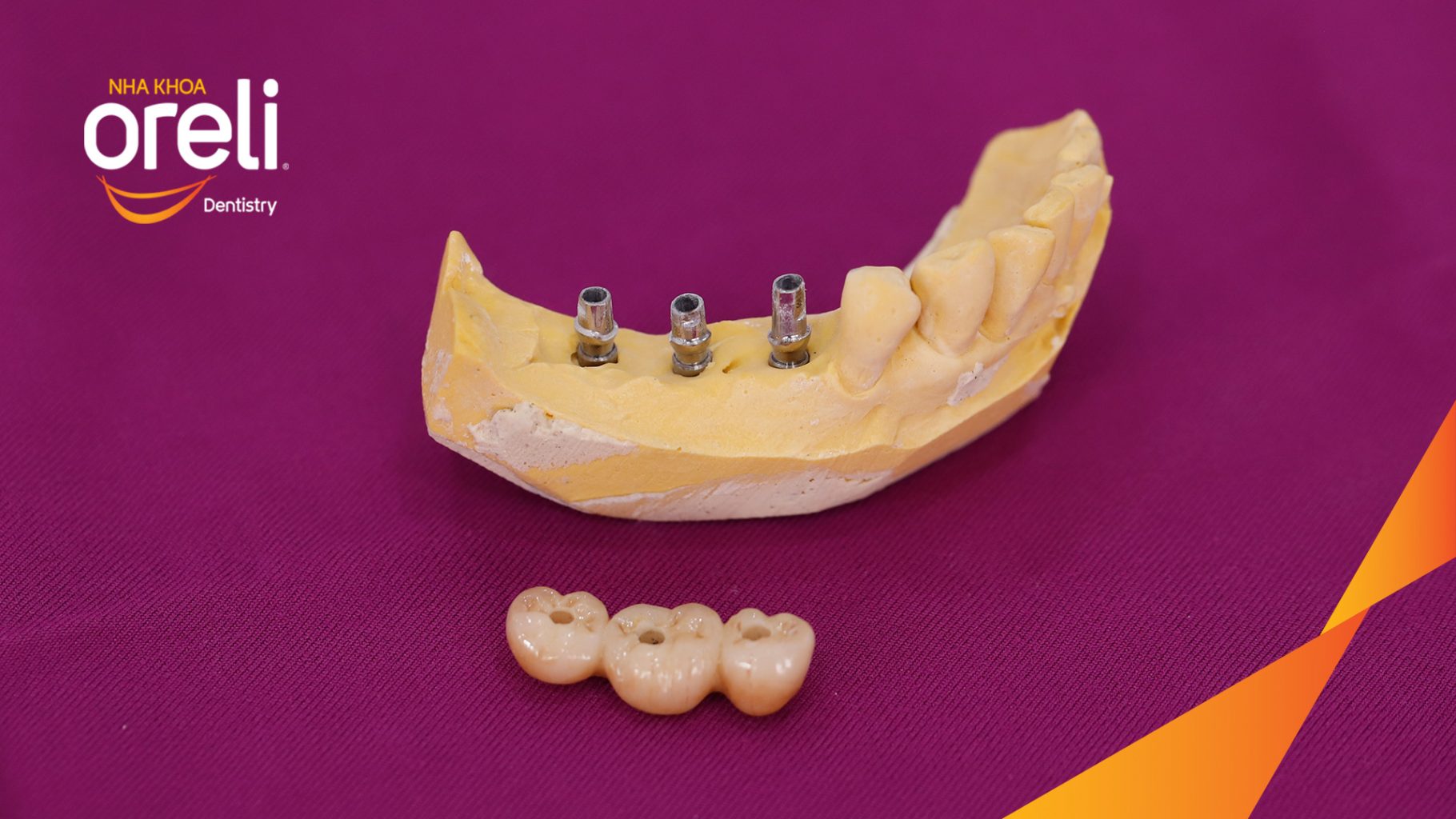 Mất răng hàm dưới trước khi điều trị tại Oreli