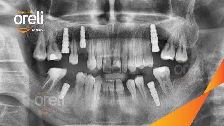 Ca Cấy Ghép Implant Phục Hồi Răng Tại Nha Khoa Oreli