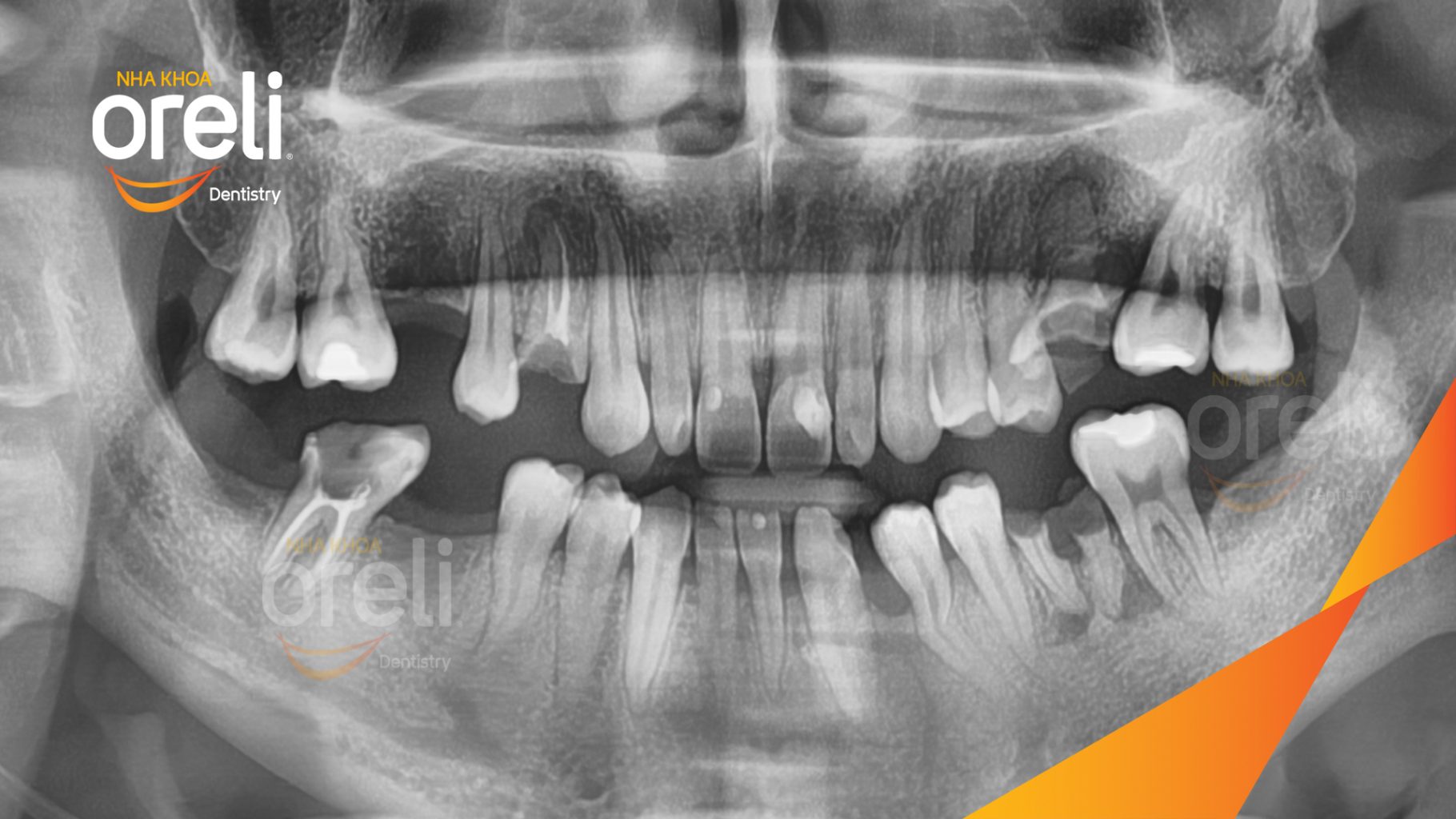 Trước điều trị: Mất răng hàm trên và hàm dưới tại Oreli