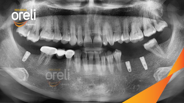 Ca Cấy Ghép Implant Phục Hồi Răng Tại Nha Khoa Oreli