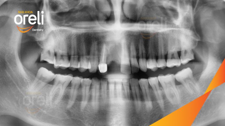Ca Cấy Ghép Implant Phục Hồi Răng Cửa Tại Nha Khoa Oreli