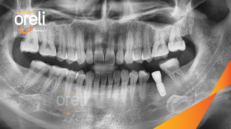 Ca Cấy Ghép Implant Phục Hồi Răng Hàm Dưới Tại Nha Khoa Oreli