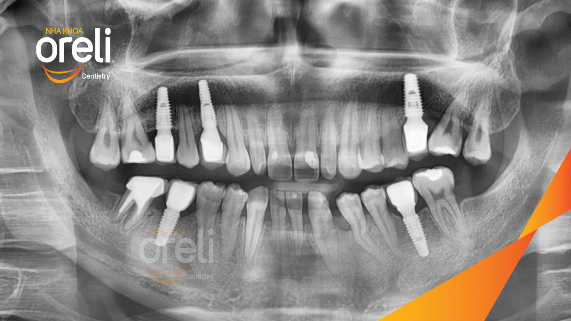 Thực hiện Cấy ghép trụ Implant chính hãng vào vùng mất răng kéo dài 3 tháng tại Oreli