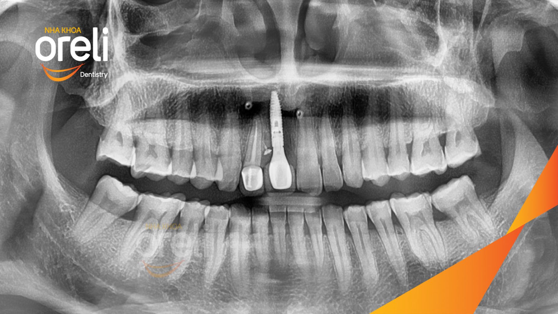 Quá trình Cấy ghép trụ Implant chính hãng vào vùng mất răng trong 3 tháng tại Oreli