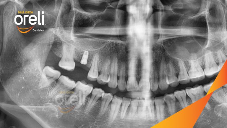 Ca Cấy Ghép Implant Hàm Dưới – Case thực tế tại Oreli