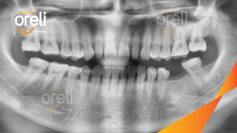 Ca Cấy Ghép Implant Phục Hồi Răng Hàm Dưới Tại Nha Khoa Oreli