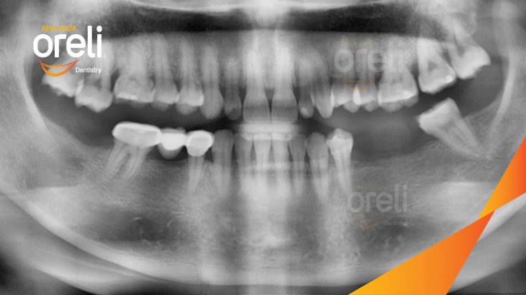 Ca Cấy Ghép Implant Phục Hồi Răng Tại Nha Khoa Oreli