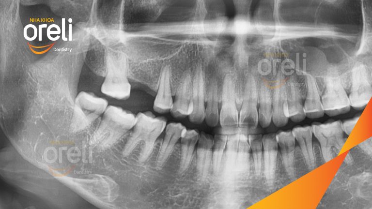 Ca Cấy Ghép Implant Hàm Dưới – Case thực tế tại Oreli