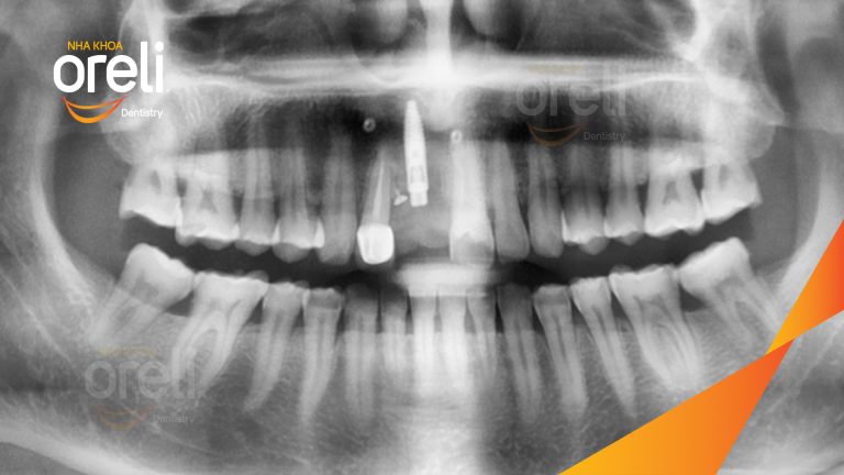 Ca Cấy Ghép Implant Phục Hồi Răng Cửa Tại Nha Khoa Oreli