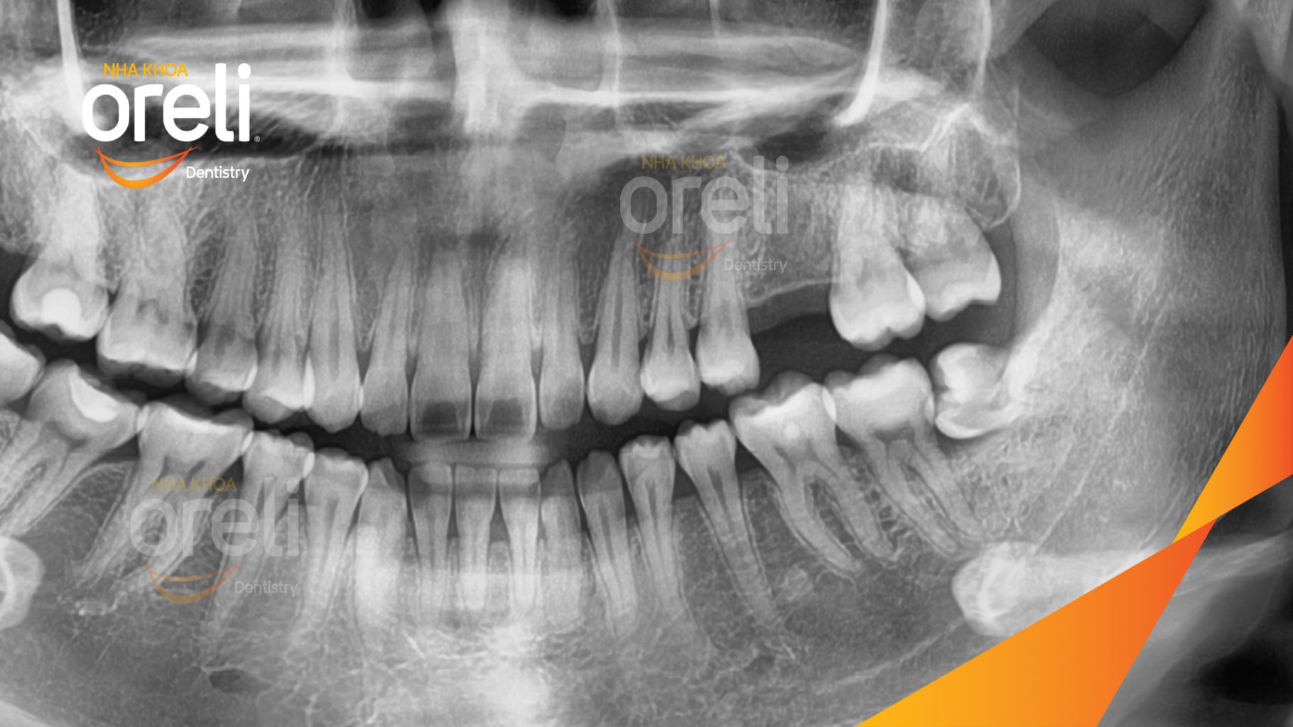 Trước điều trị: Mất răng hàm trên tại Oreli