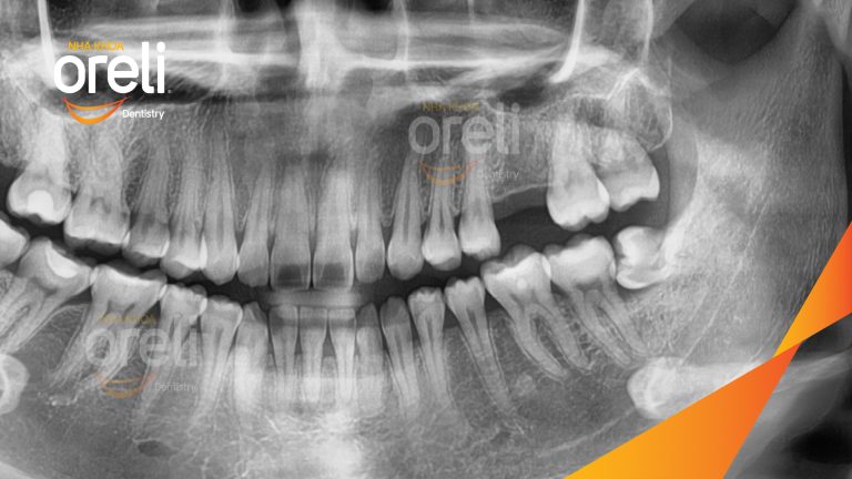 Ca Cấy Ghép Implant Phục Hồi Răng Tại Nha Khoa Oreli