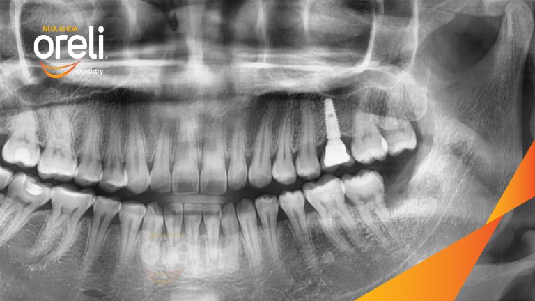 Ca Cấy Ghép Implant Phục Hồi Răng Tại Nha Khoa Oreli