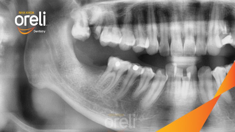 Ca Cấy Ghép Implant Phục Hồi Răng Tại Nha Khoa Oreli