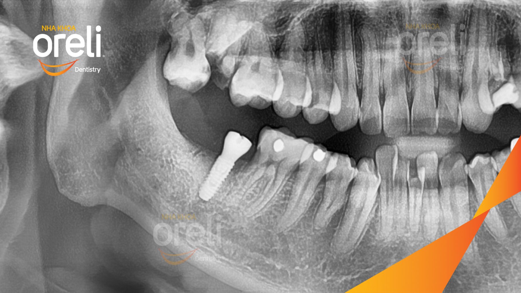 Mất răng hàm dưới trước khi điều trị tại Oreli