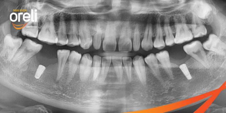 Ca Cấy Ghép Implant Hàm Dưới – Case thực tế tại Oreli