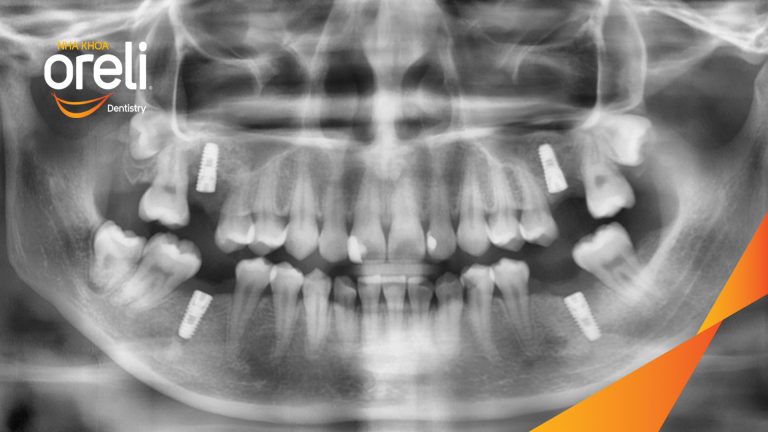 Ca Cấy Ghép Implant Phục Hồi Răng Tại Nha Khoa Oreli