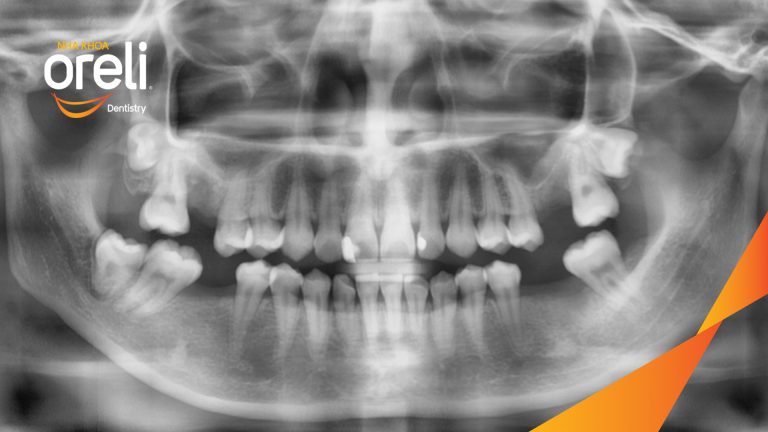Ca Cấy Ghép Implant Phục Hồi Răng Tại Nha Khoa Oreli