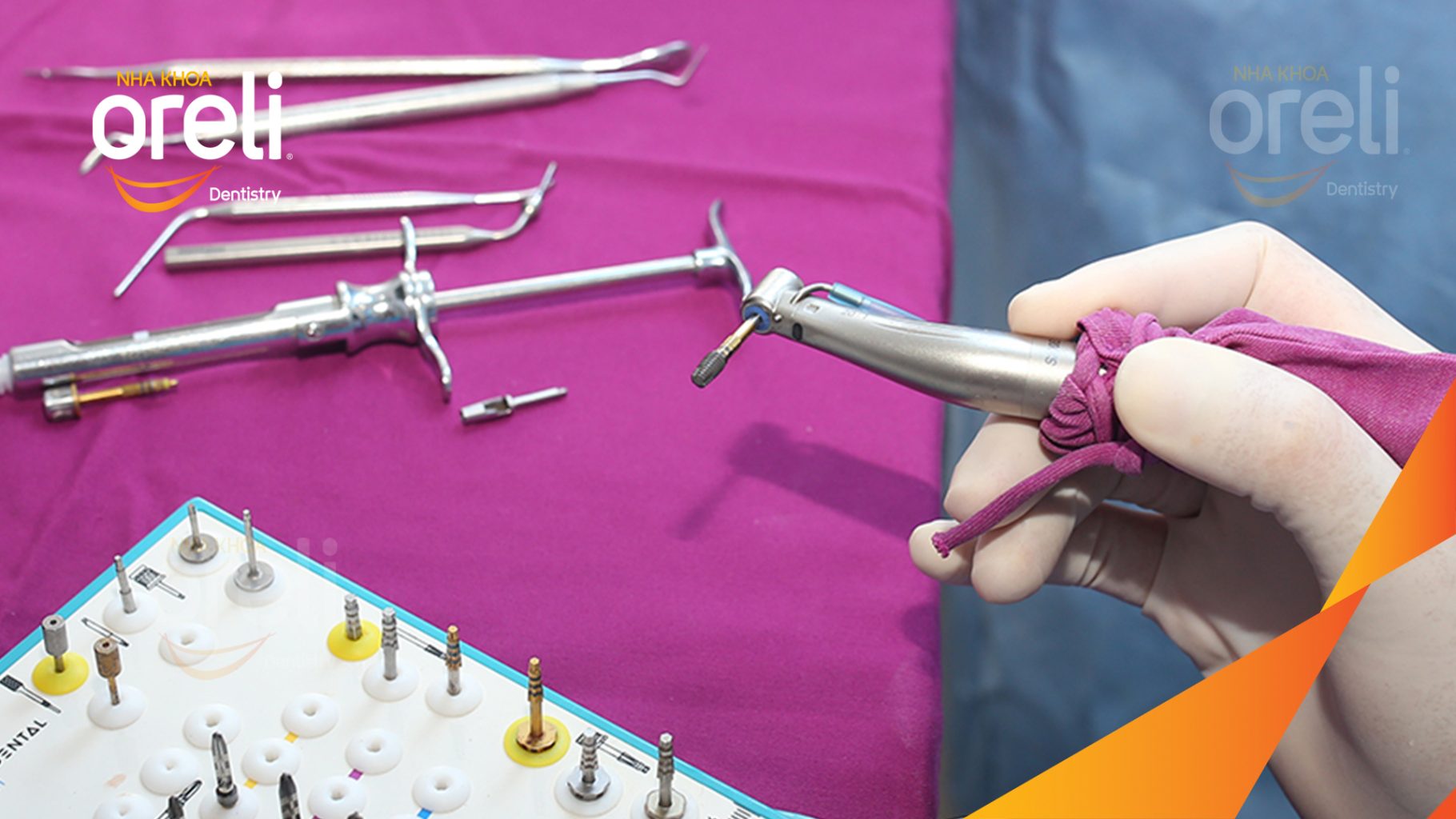 Thực hiện Cấy ghép trụ Implant chính hãng vào vùng mất răng kéo dài 3 tháng tại Oreli
