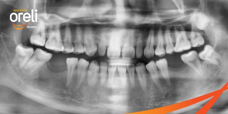 Ca Cấy Ghép Implant Hàm Dưới – Case thực tế tại Oreli
