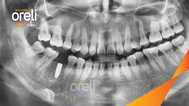 Ca Cấy Implant Hàm Dưới Tại Nha Khoa Oreli