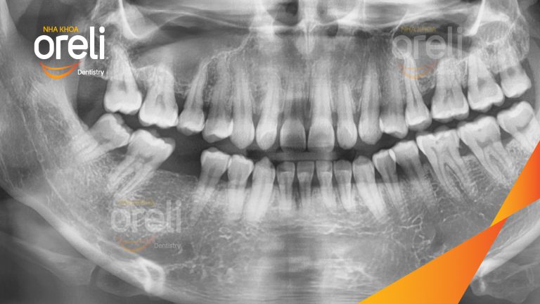 Ca Cấy Implant Hàm Dưới Tại Nha Khoa Oreli