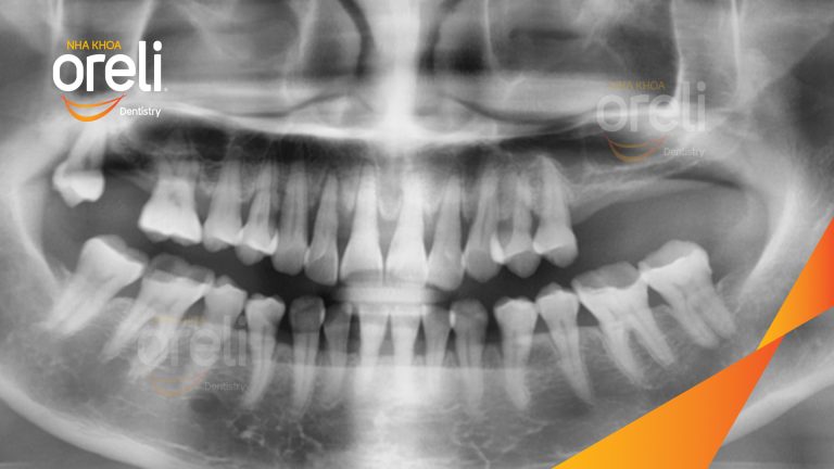 Ca Cấy Ghép Implant Phục Hồi Răng Tại Nha Khoa Oreli