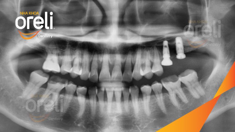 Ca Cấy Ghép Implant Phục Hồi Răng Tại Nha Khoa Oreli