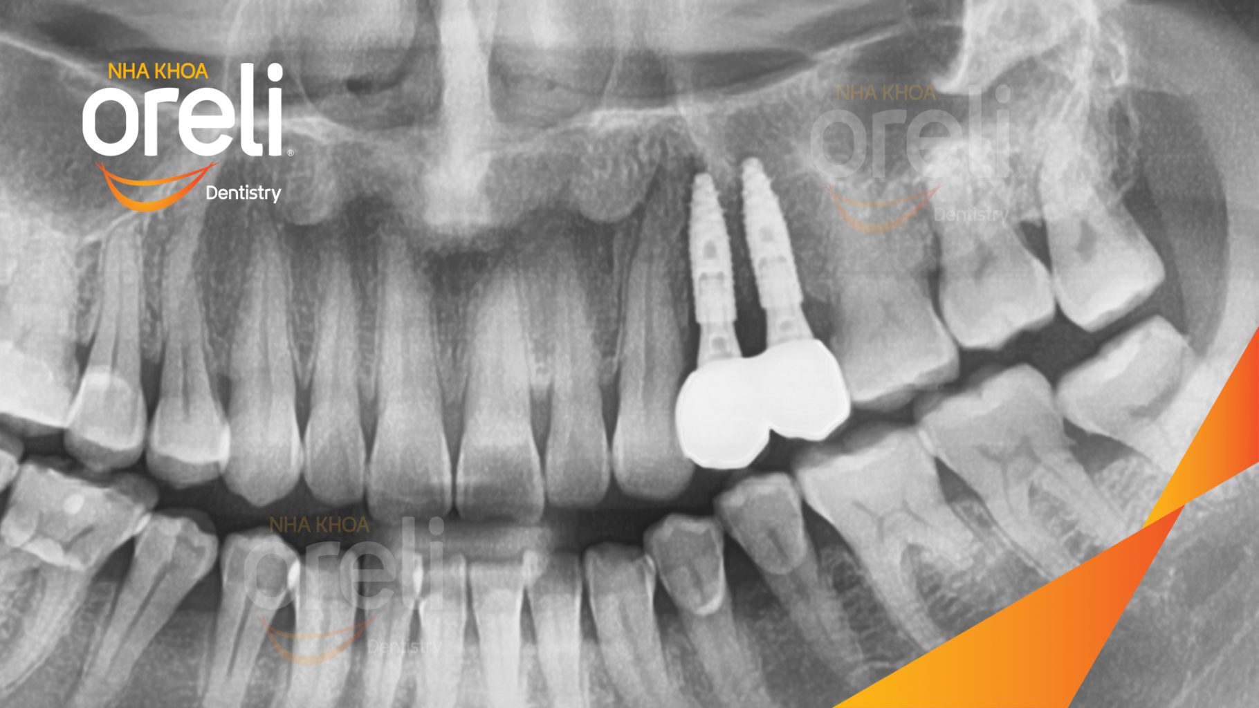 Thực hiện Cấy ghép trụ Implant chính hãng vào vùng mất răng kéo dài 3 tháng tại Oreli