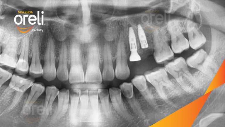 Ca Cấy Ghép Implant Phục Hồi Răng Tại Nha Khoa Oreli
