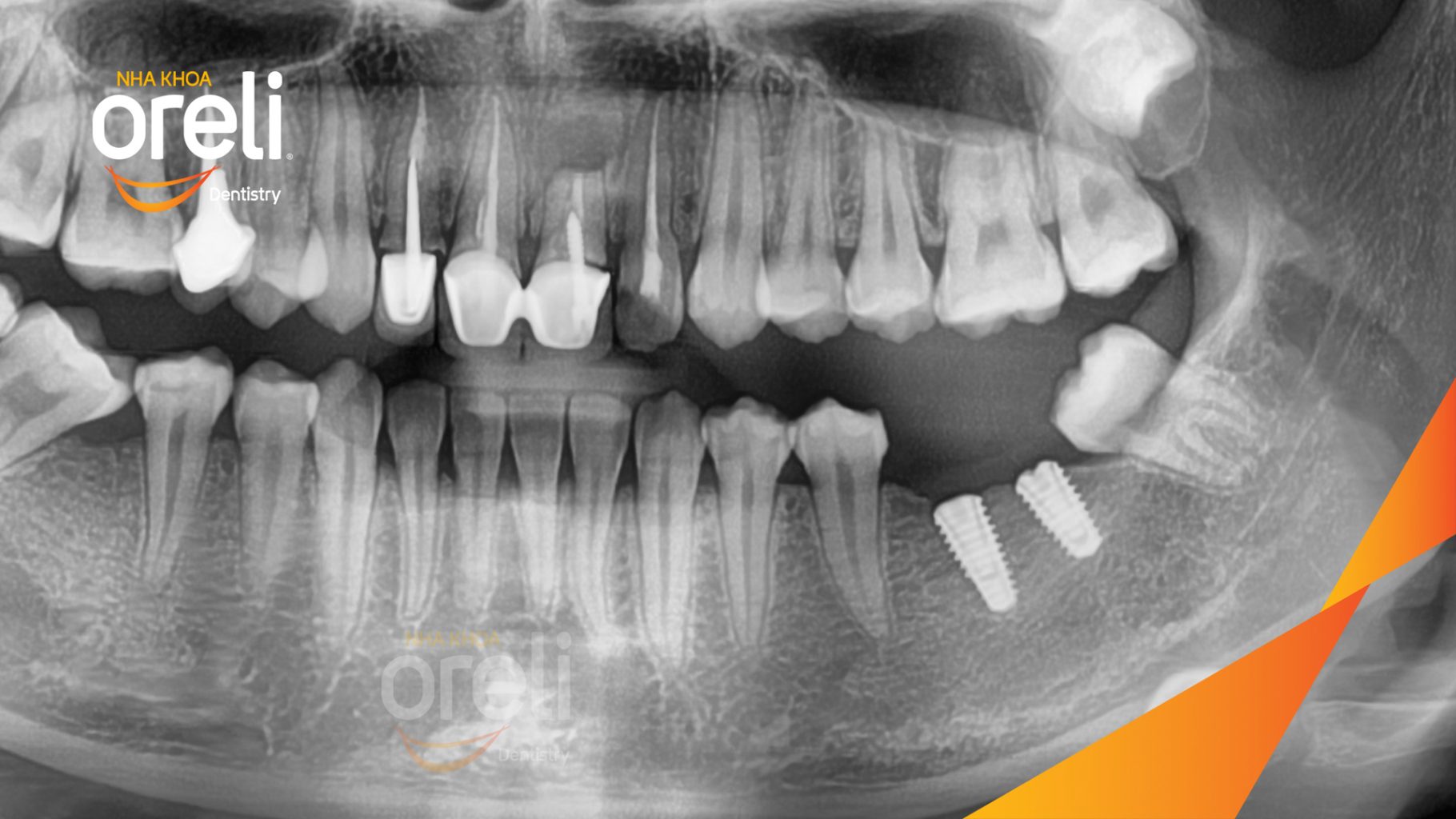 Mất răng hàm dưới trước khi điều trị tại Oreli