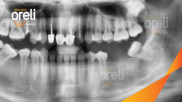 Ca Cấy Ghép Implant Phục Hồi Răng Tại Nha Khoa Oreli