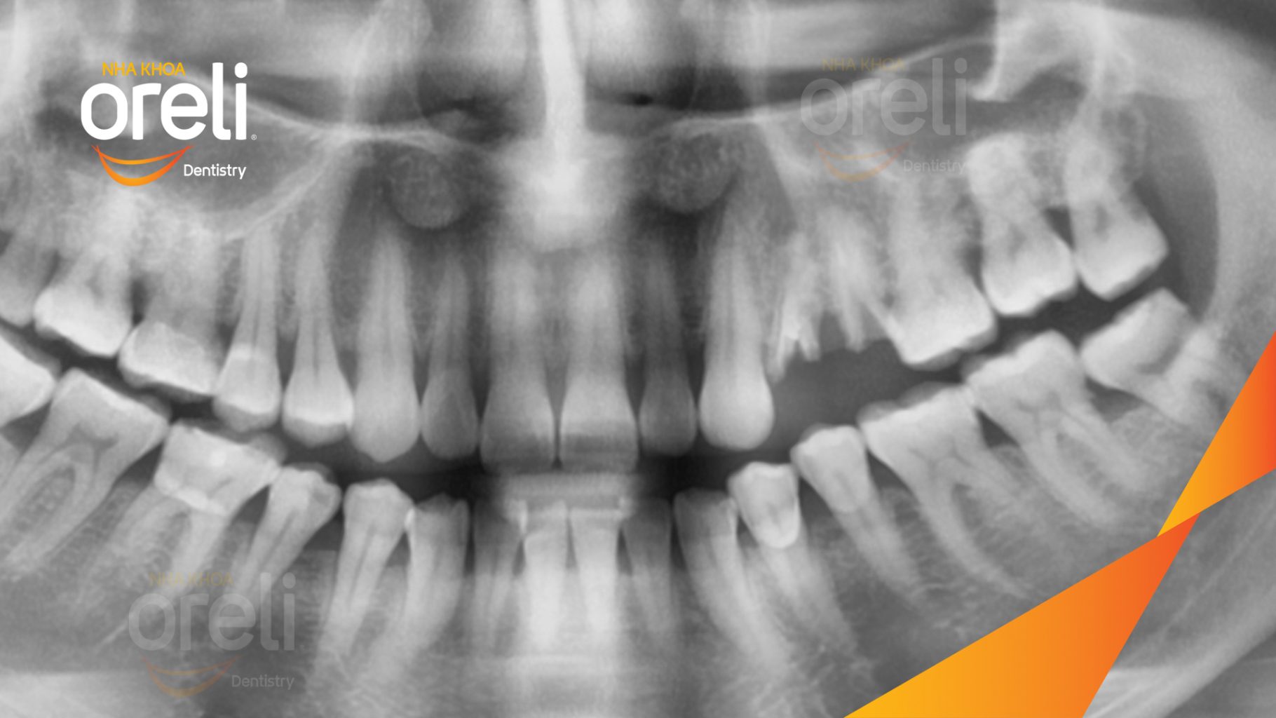 Trước điều trị: Mất răng hàm trên tại Oreli
