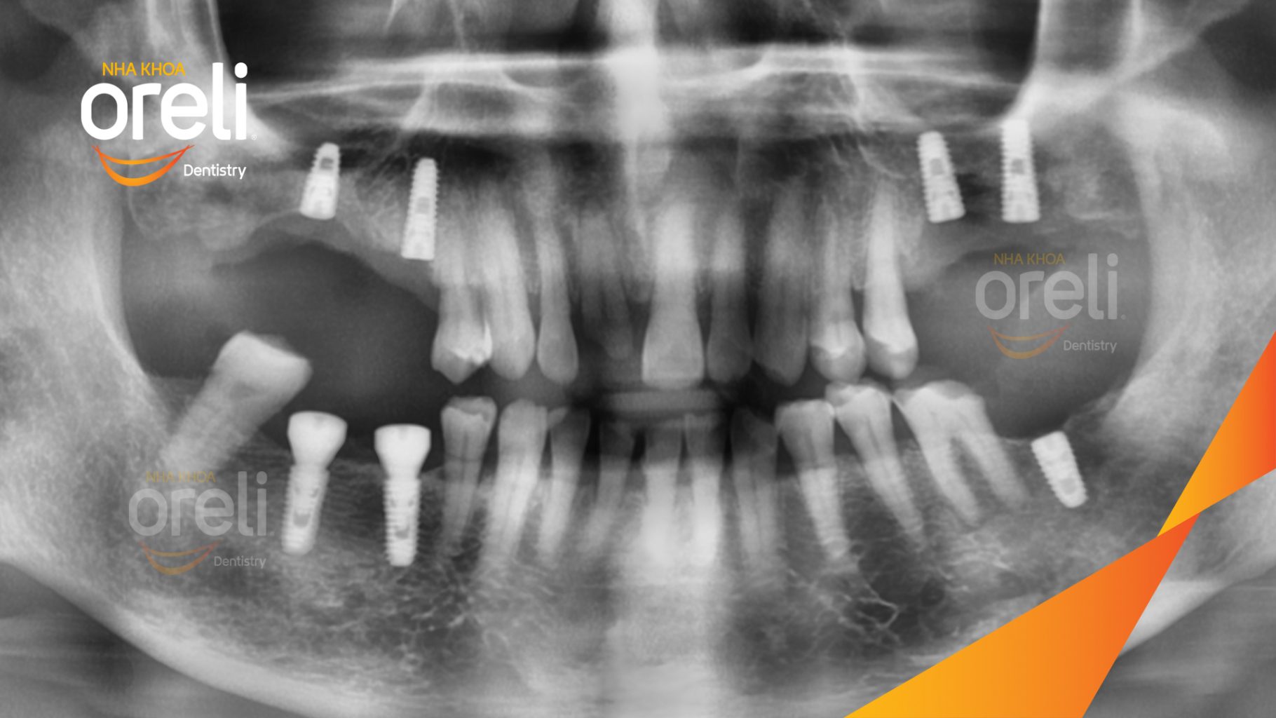 Mất răng hàm trên và dưới thời gian dài trước khi điều trị tại Oreli