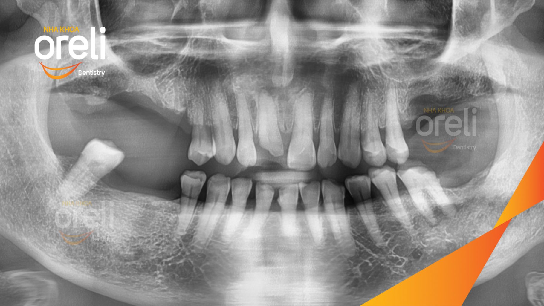 Trước điều trị: Mất răng hàm trên và dưới thời gian dài tại Oreli