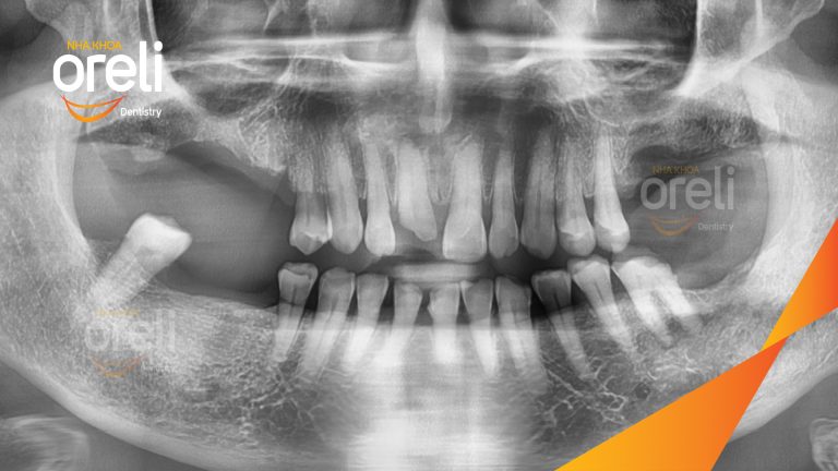 Ca Cấy Ghép Implant Phục Hồi Răng Tại Nha Khoa Oreli