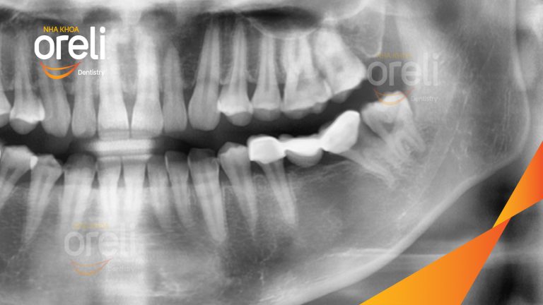 Ca Cấy Ghép Implant Hàm Dưới – Case thực tế tại Oreli