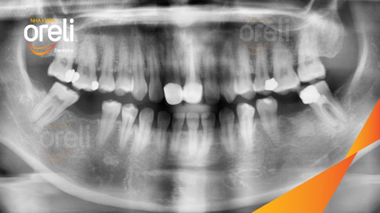 Ca Cấy Ghép Implant Hàm Dưới – Case thực tế tại Oreli