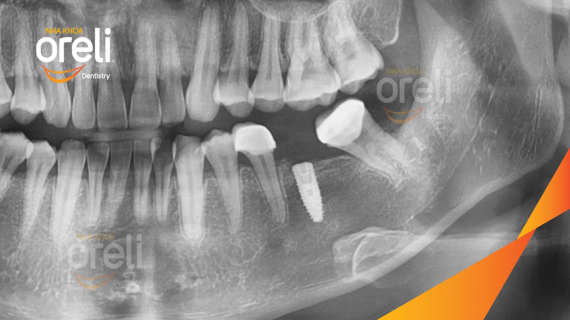 Mất răng hàm dưới trước khi điều trị tại Oreli