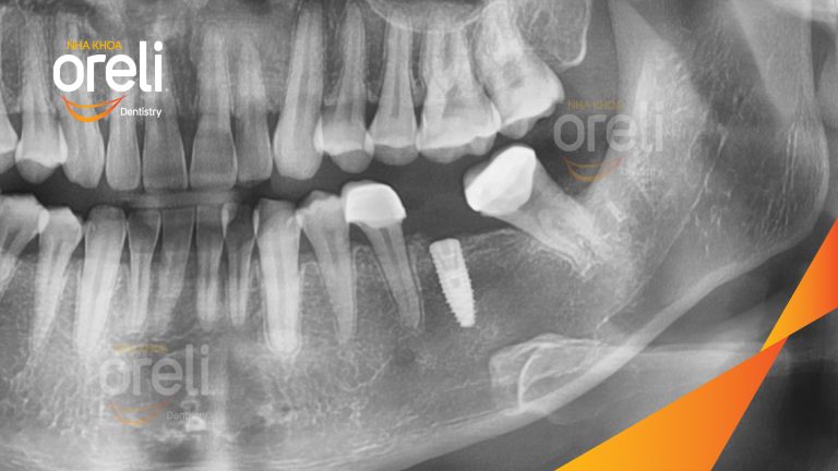Ca Cấy Ghép Implant Hàm Dưới – Case thực tế tại Oreli