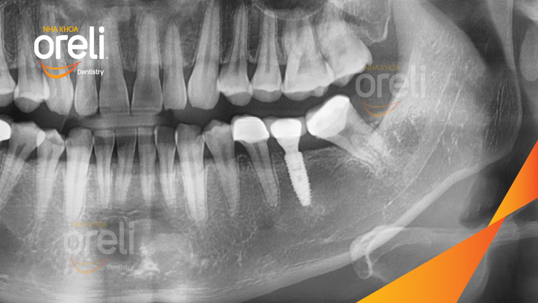 Thực hiện Cấy ghép trụ Implant chính hãng vào vùng mất răng kéo dài 3 tháng tại Oreli