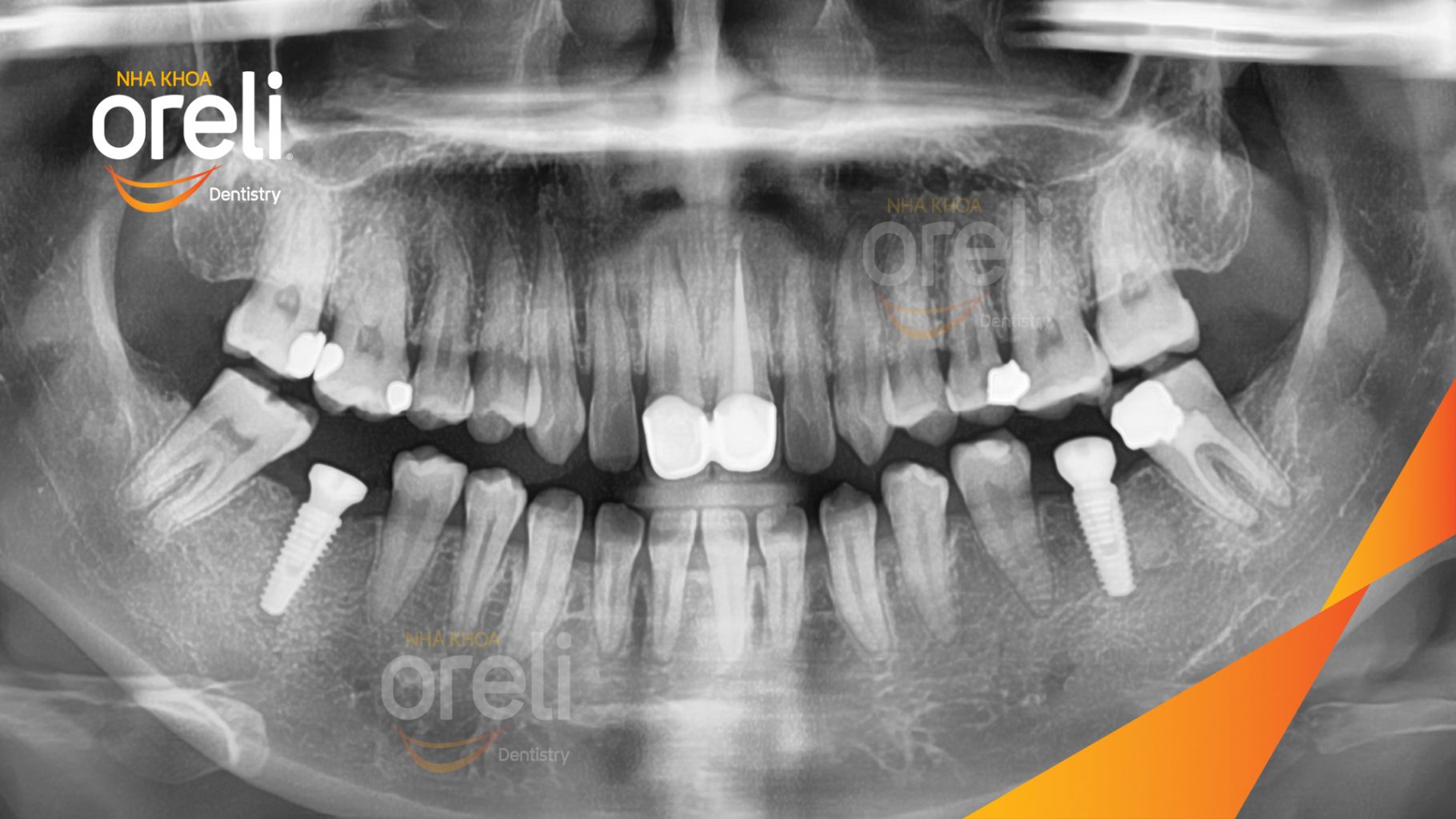 Mất răng hàm dưới trước khi điều trị tại Oreli
