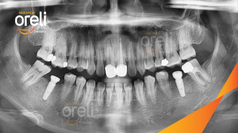 Ca Cấy Ghép Implant Hàm Dưới – Case thực tế tại Oreli