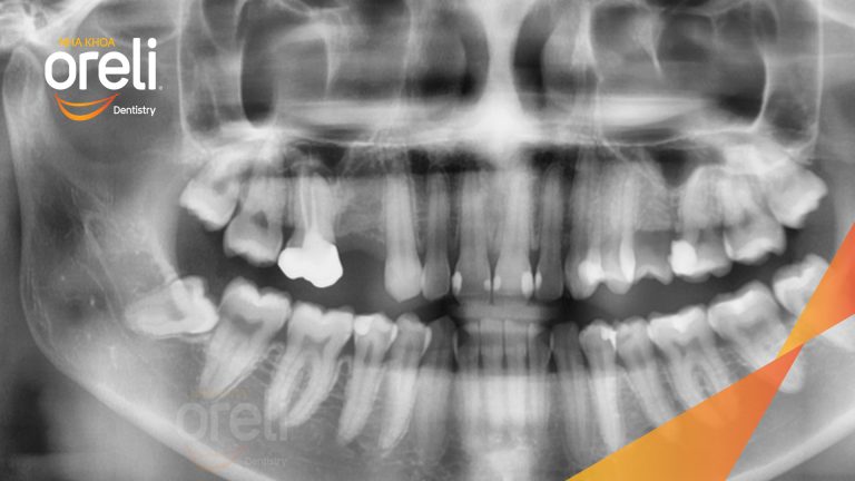 Ca Cấy Ghép Implant Hàm Trên – Case thực tế tại Oreli
