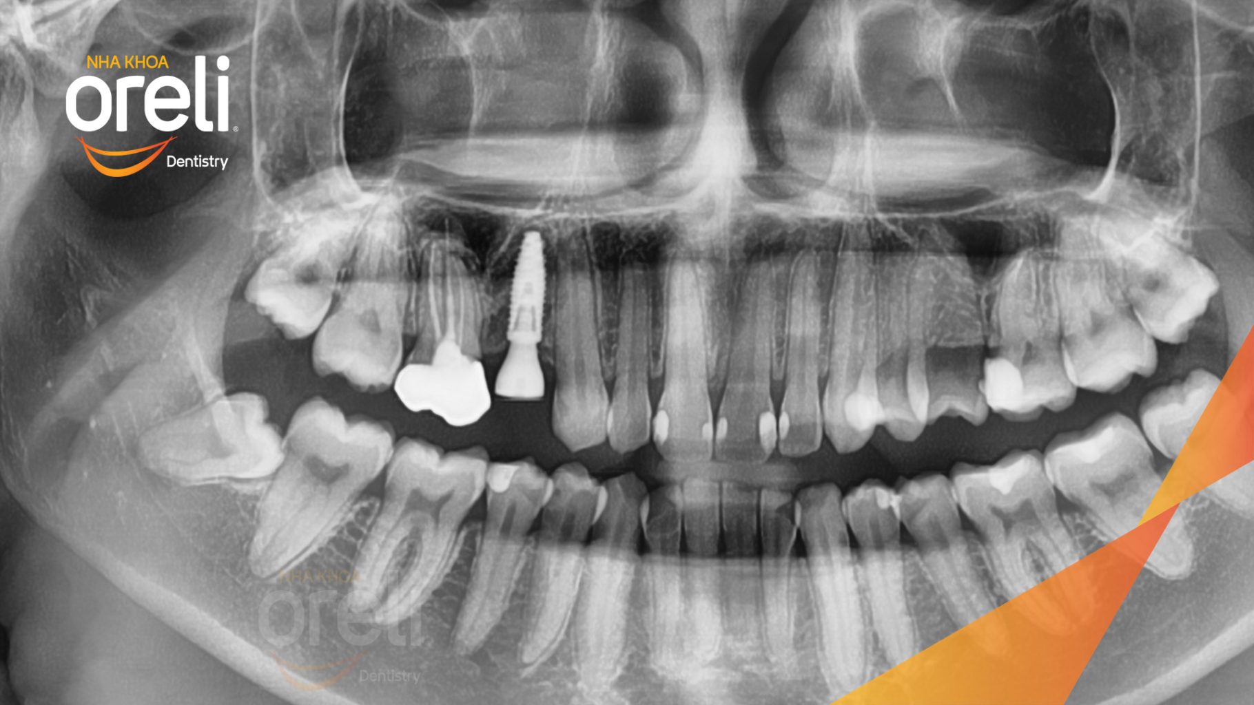 Mất răng hàm trên trước khi điều trị tại Oreli