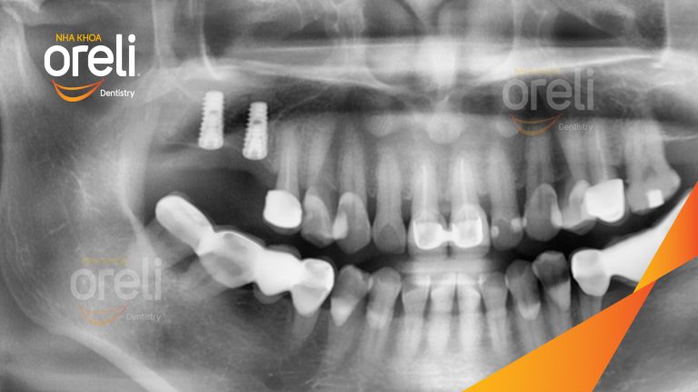 Ca Cấy Ghép Implant Phục Hồi Răng Tại Nha Khoa Oreli