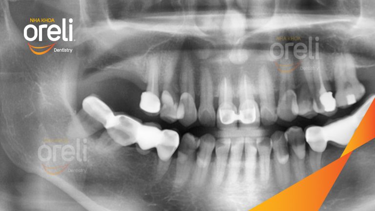 Ca Cấy Ghép Implant Phục Hồi Răng Tại Nha Khoa Oreli