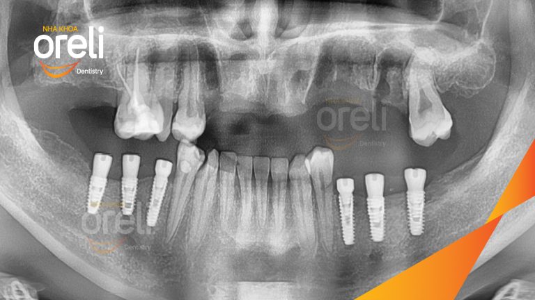 Ca Cấy Ghép Implant Phục Hồi Răng Hàm Dưới Tại Nha Khoa Oreli