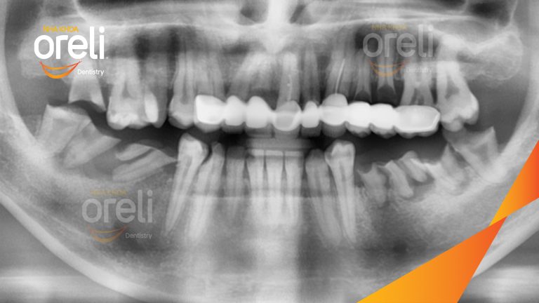 Ca Cấy Ghép Implant Phục Hồi Răng Hàm Dưới Tại Nha Khoa Oreli
