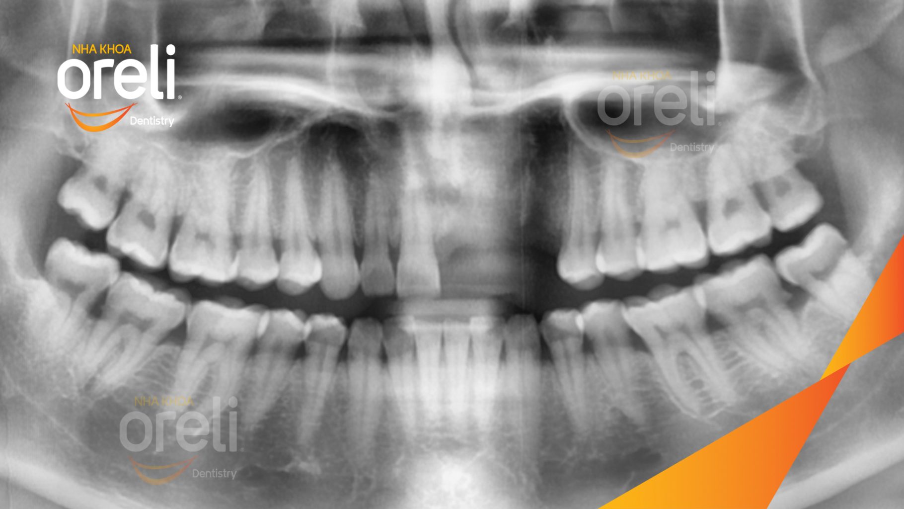 Trước điều trị: Mất răng hàm trên tại Oreli